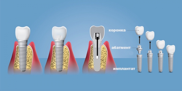 Имплантация зубов: перспективы и новые технологии