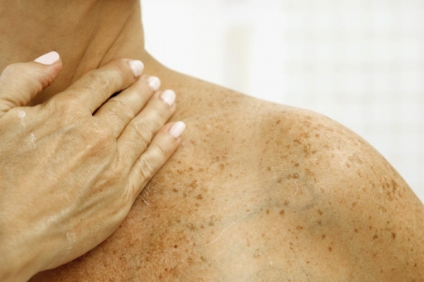 Пигментные заболевания кожи