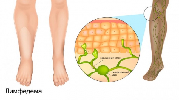 Лимфедема: эффективные подходы к диагностике и лечению