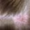 Атерома волосистой части головы
