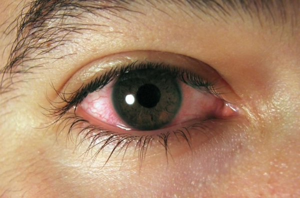 Меланома глаз
