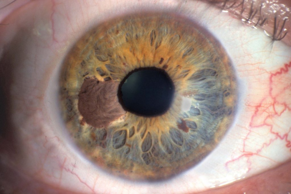 Меланома глаз